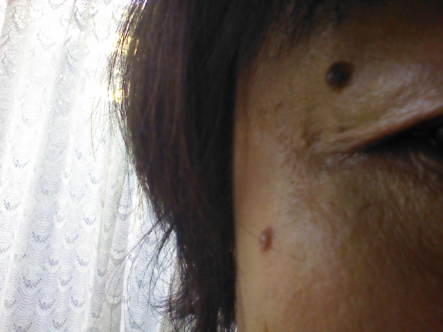 高周波によるホクロ・いぼ除去